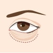 Lower-Blepharoplasty-Eyelid-Surgery_illustration