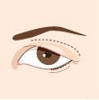 Upper-Blepharoplasty-Eyelid-Surgery_illustration