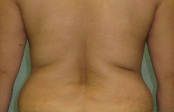 Chicago's Best Flank Fat Removal: Get Results Without Liposuction