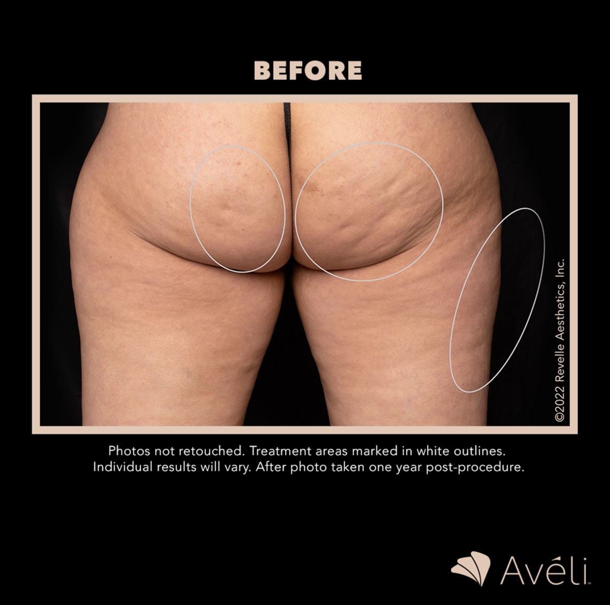 I Tried Avéli Cellulite Treatment — With Before and Afters